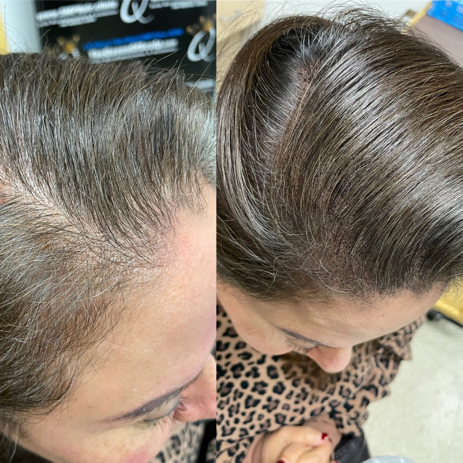 Scalp micropigmentation Newport for women, enhancing hair density and creating a fuller, natural look to conceal thinning areas.